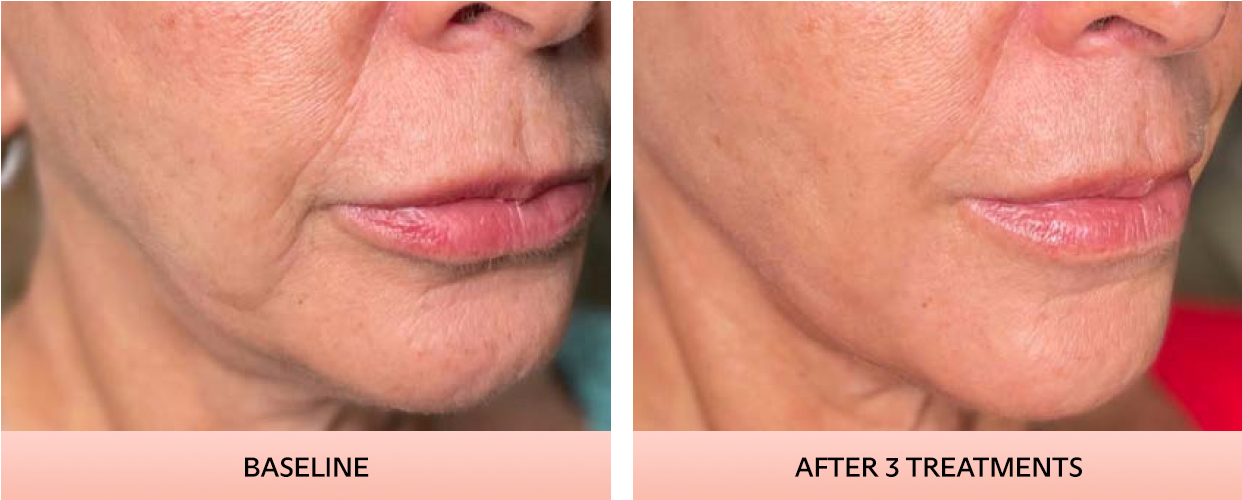 jaw-line-3