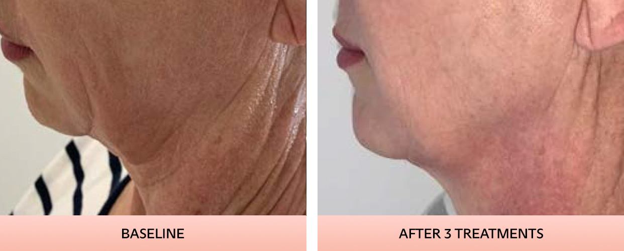jawline-2
